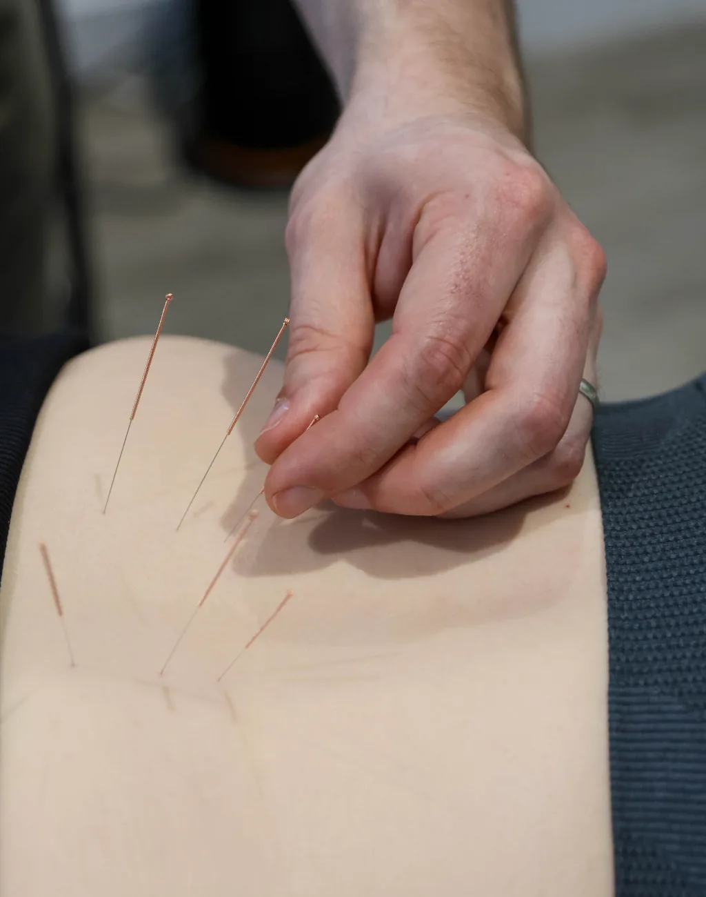 Medical acupuncture and dry needling at BetterMe Physiotherapy
